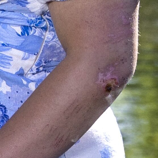 Image of a high school seniors girl elbow with a bad abrasion on it after a 4x4 accident.